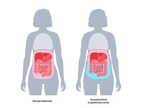 Ascites disease poster Stock Illustration