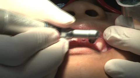 Asian Boy Getting His Teeth Checked At The Dentist 스톡 동영상 32376828