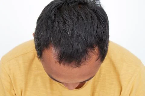 Asian man Hair loss Stock Photos
