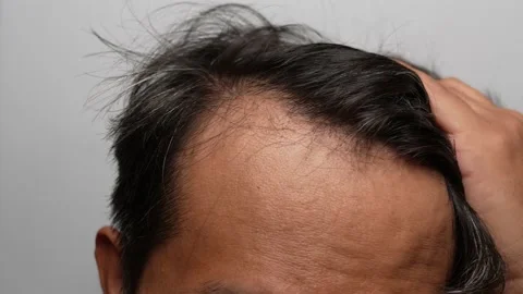 Asian man scratching his head with hoary hair. Stock Footage 231234911