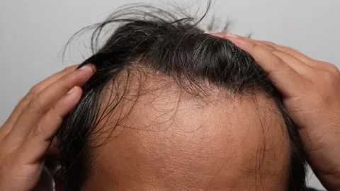 Asian man scratching his head with hoary hair. Stock Footage 231237780