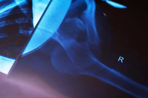 Assessment of prosthetic positioning and bone health during postoperative Stock Photos