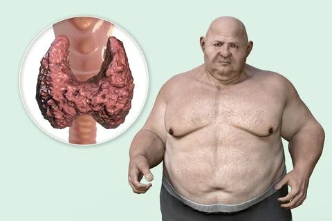 Association between autoimmune thyroid disease and obesity, conceptual 3D ill Stock Illustration