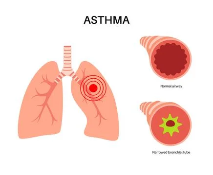 Asthma lung disease Stock Illustration