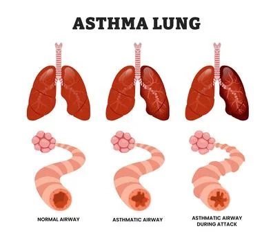 Asthma Lung Stages development process with lung airway during asthma attac.. Stock Illustration