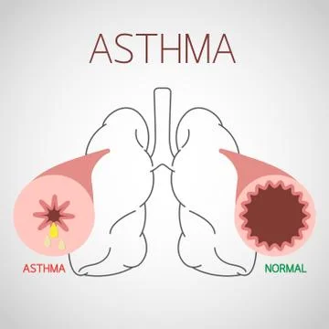 Asthma vector icon illustration Stock Illustration