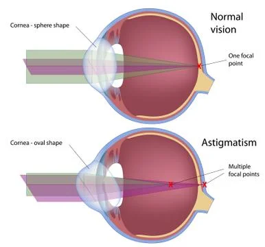 Astigmatism, a common eye defect Stock Illustration