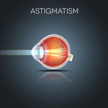 Astigmatism Stock Illustration