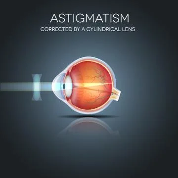 Astigmatism Stock Illustration