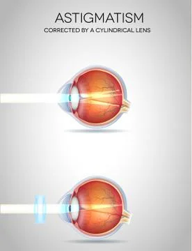 Astigmatism Illustrazione stock