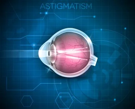 Astigmatism Stock Illustration