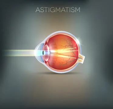 Astigmatism, vision disorder Stock Illustration