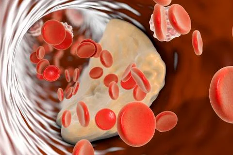 Atheroma plaque inside artery Stock Illustration