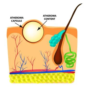 Atheroma structure. The structure of moles on the skin. Infographics. Vector Stock Illustration