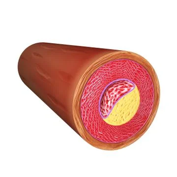 Atherosclerosis anatomy Stock Illustration