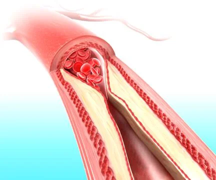 Atherosclerosis anatomy Ilustração Stock