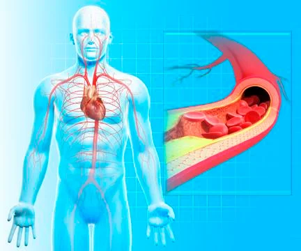 Atherosclerosis; artwork Stock Illustration