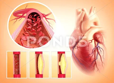 Atherosclerosis; artwork Stock Illustration