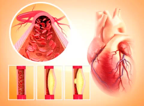 Atherosclerosis; artwork Stock Illustration