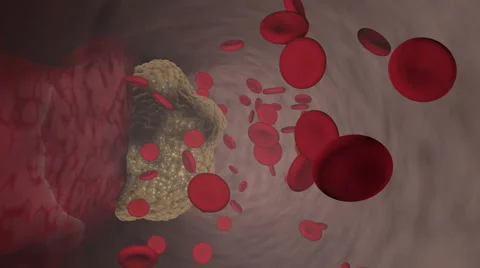 Atherosclerosis disease animation. Stock Footage