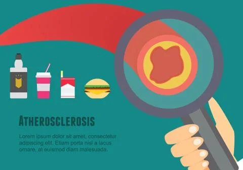 Atherosclerosis flat illustration Stock Illustration