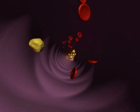 Atherosclerosis Stock Footage 1035501
