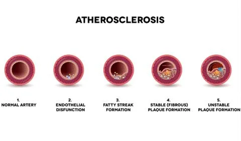 Atherosclerosis formation Stock Illustration