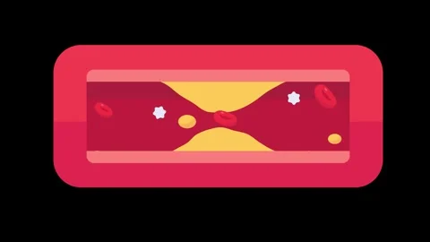 Atherosclerosis with high cholesterol Causes high blood fat and clogs arter.. 库存影片 258186855