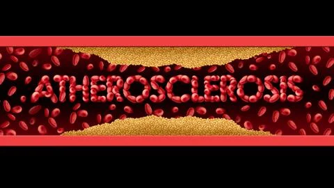 Atherosclerosis Stock Illustration