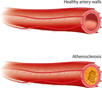 Atherosclerosis Stock Illustration