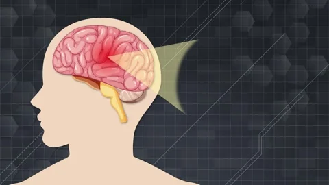 Atherosclerosis Progression in the Human Brain Stock Footage 307153416