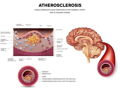 Atherosclerosis. Stable plaque formation Stock Illustration
