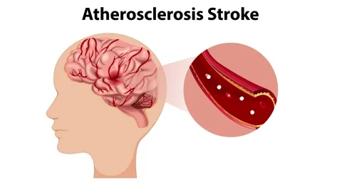 Atherosclerosis Stroke Animation Stock Footage 293560457