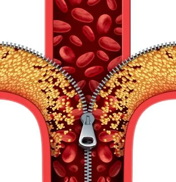 Atherosclerosis Therapy Stock Illustration