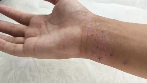 Atopic dermatitis AD, atopic eczema, skin inflammation Stock Footage 314880293