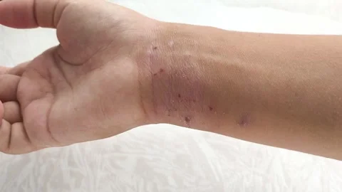 Atopic dermatitis AD, atopic eczema, skin inflammation Stock Footage 314880315