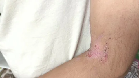 Atopic dermatitis AD, atopic eczema, skin inflammation 動画素材 314880329