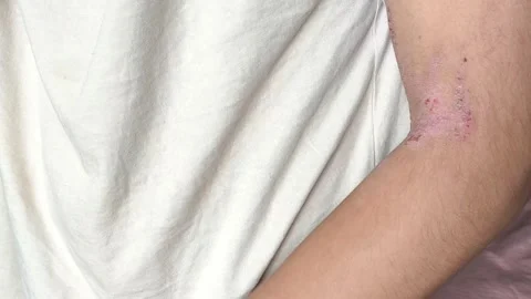 Atopic dermatitis AD, atopic eczema, skin inflammation Vídeo Stock 314881514
