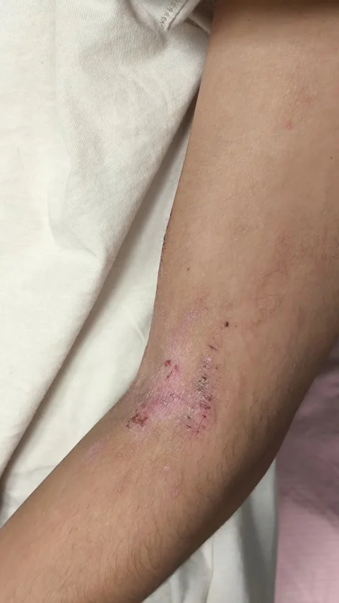 Atopic dermatitis AD, atopic eczema, skin inflammation Видео 314882427