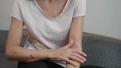 Atopic dermatitis on the arms Stock-Footage 118643106