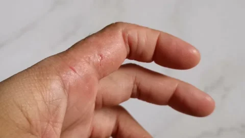 Atopic Dermatitis Eczema Video stock 205827538