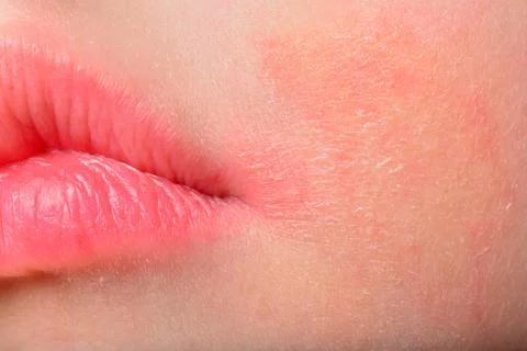 Atopic Dermatitis 스톡 사진