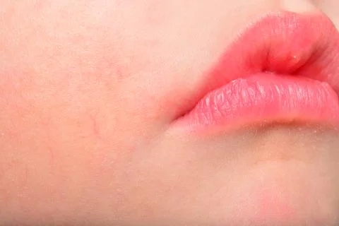 Atopic Dermatitis 写真素材