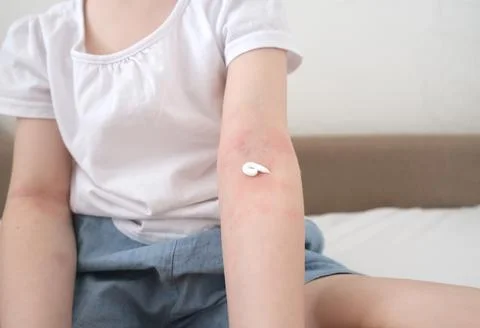 Atopic dermatitis Stock Photos