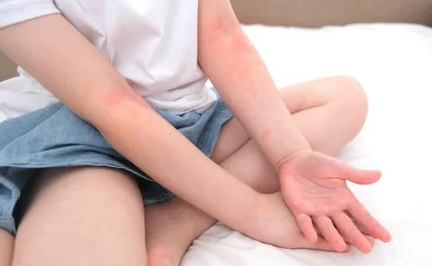Atopic dermatitis Stock Photos