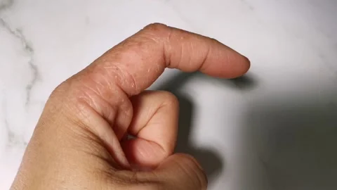 Atopic Dermatitis with Wound on Hands Stock Footage 240710742