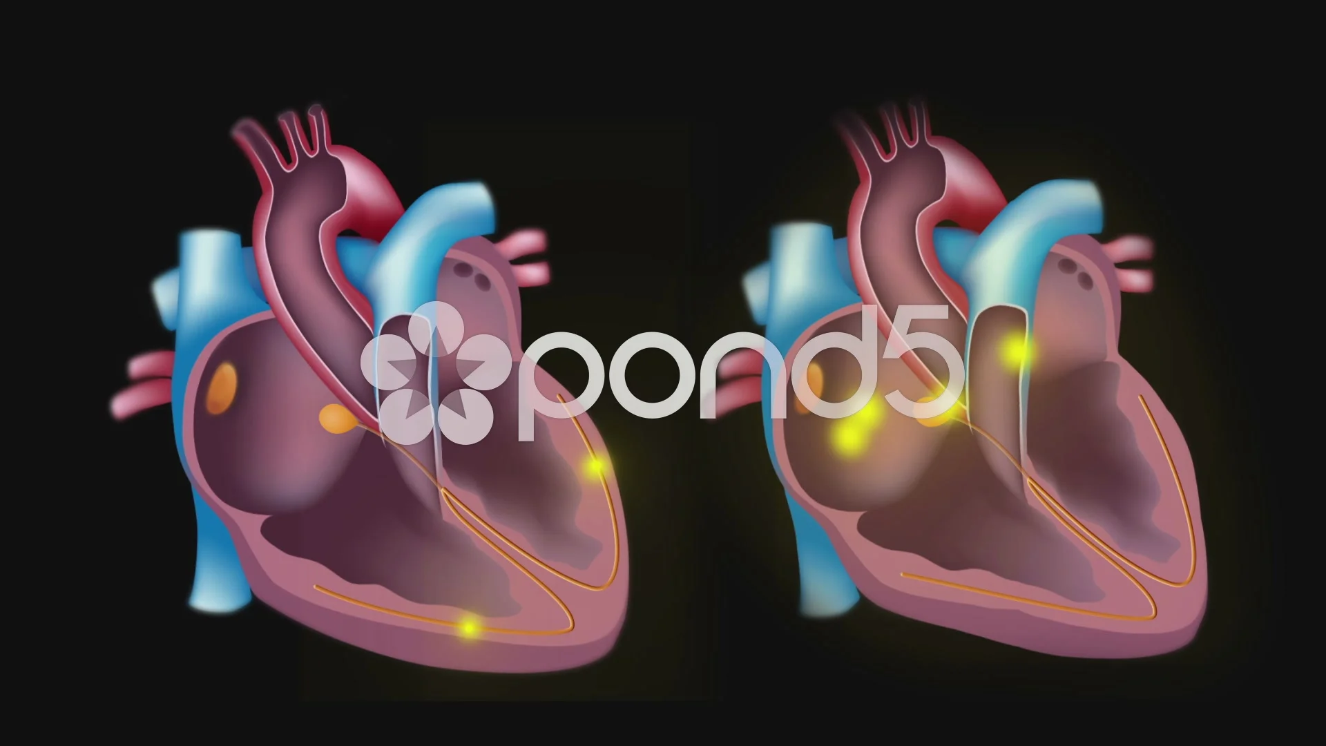 Atrial fibrillation animation loop | Stock Video | Pond5
