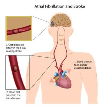 Atrial fibrillation causing stroke Stock Illustration