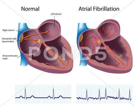 Atrial fibrillation: Vector Graphic Illustration #12315145