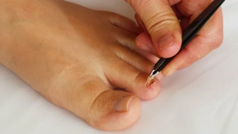 Attempting to remove a partially detached, dead toenail with tweezers Stock Footage 172012959